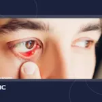 گل مژه چیست؟ + علائم و درمان سریع گل مژه