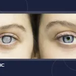 هر آنچه باید درباره فشار چشم (IOP) بدانید...