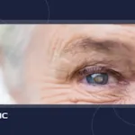 آیا بعد از عمل آب مروارید عینک آفتابی بزنیم؟