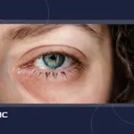 زخم چشم و زخم قرنیه چیست؟ علائم، دلایل، پیشگیری و درمان