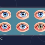 بیماری های چشمی که درمان ندارند! + راهنمای دقیق تشخیص