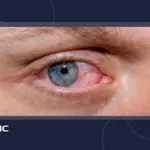 خشکی چشم چیست؟دلایل، علائم و روش های درمان خانگی و تخصصی