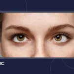 همه چیز درباره انحراف چشم، علائم و درمان