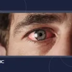 آفتاب سوختگی چشم چیست و چگونه درمان می شود؟