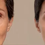 بوتاکس صورت: راز جوانی، عوارض ناگفته و روش  جایگزین  برای جوانسازی پوست!