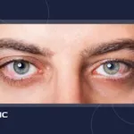 همه چیز درباره خارش چشم، علت و درمان